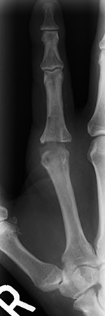 Swanson silicone joint prosthesis